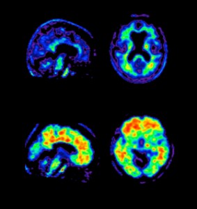 Вверху - мозг, поражённый болезнью Альцгеймера, внизу - здоровый мозг